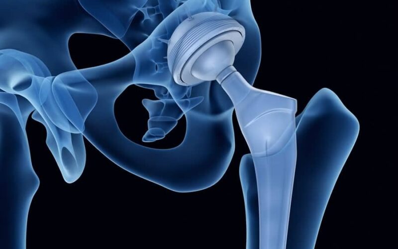 Stryker Hip Recall and DePuy Hip Recall