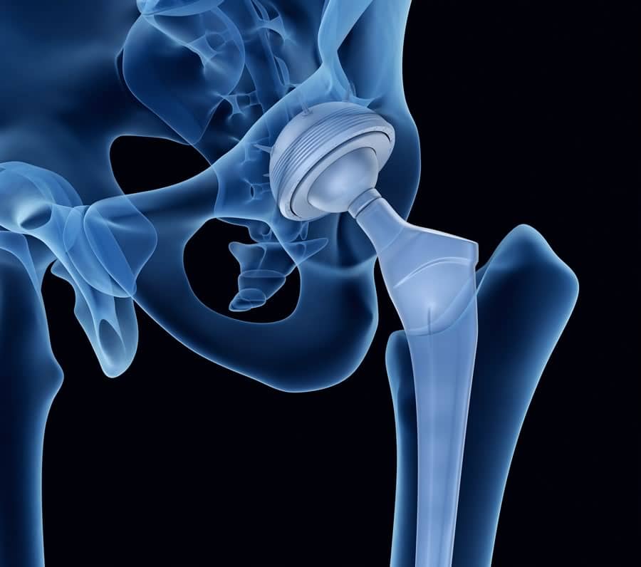 Stryker Hip Recall and DePuy Hip Recall